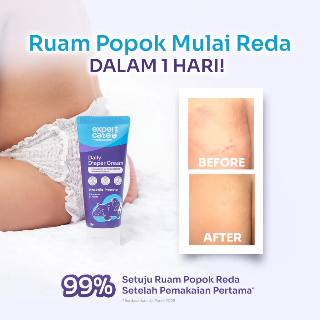 Diaper Rash Cream - Expert Care Daily Diaper Cream 40gr - Redakan dan Cegah Ruam Popok